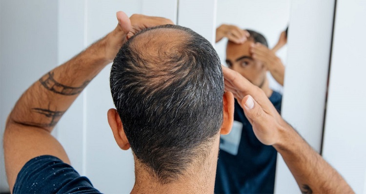 টাক হওয়ার ঝুঁকি বাড়ায় যেসব খাবার