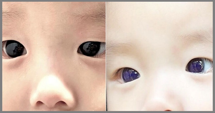 করোনা চিকিৎসায় পাল্টে গেলো শিশুর চোখের রং