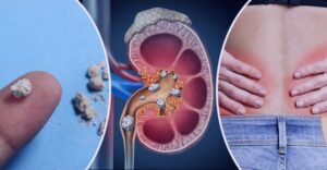 কিডনিতে পাথর হওয়ার ৫ লক্ষণ এবং করণীয়