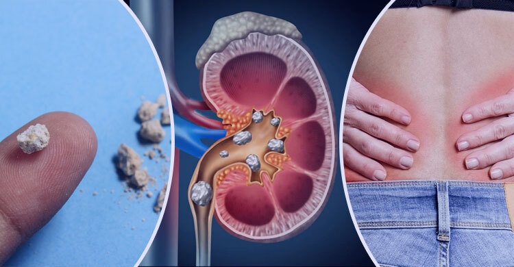 কিডনিতে পাথর হওয়ার ৫ লক্ষণ এবং করণীয়