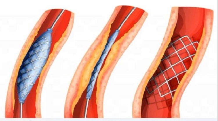 রোগীদের জিম্মি করে হার্টের রিংয়ের দাম বাড়ানোর পাঁয়তারা