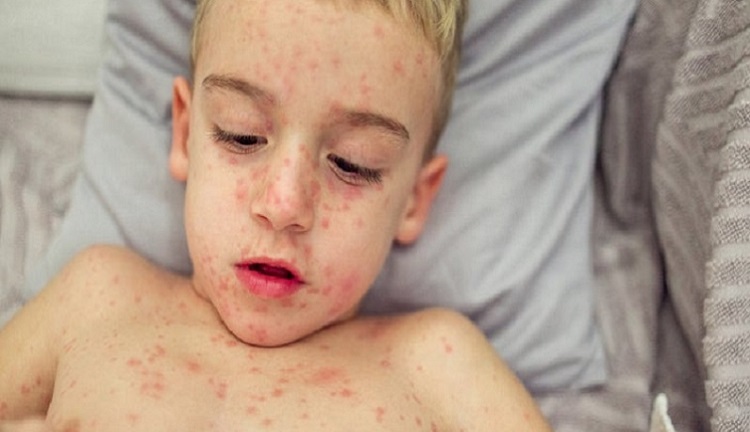 বিশ্বের অর্ধেকেরও বেশি দেশ হামের উচ্চ ঝুঁকিতে ডব্লিউএইচও