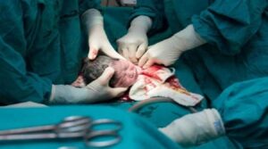 এক বছরে সিজারিয়ান ডেলিভারি বেড়েছে ৯ শতাংশের বেশি বিবিএস