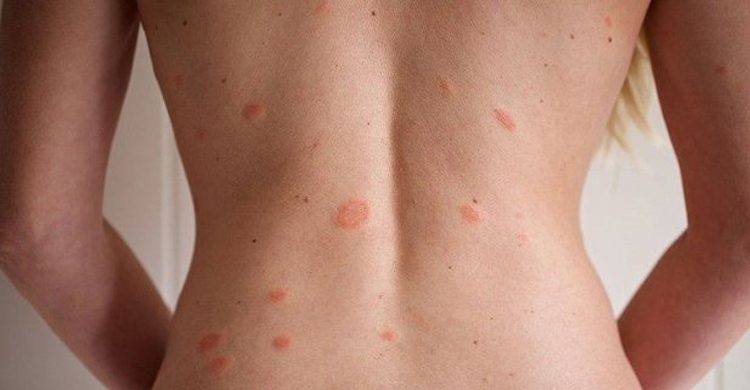 গরমে যেসব চর্মরোগ হতে পারে, কী করবেন